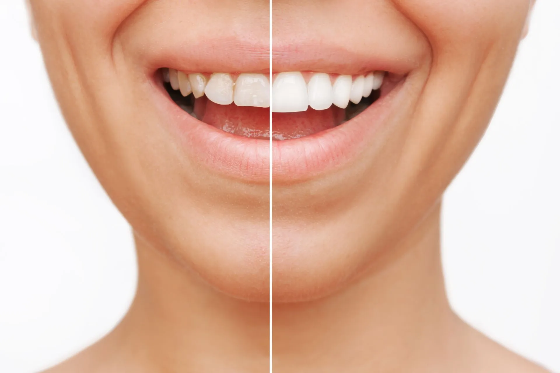 Smiling woman before and after treatment, showcasing a beautiful dental crown transformation.