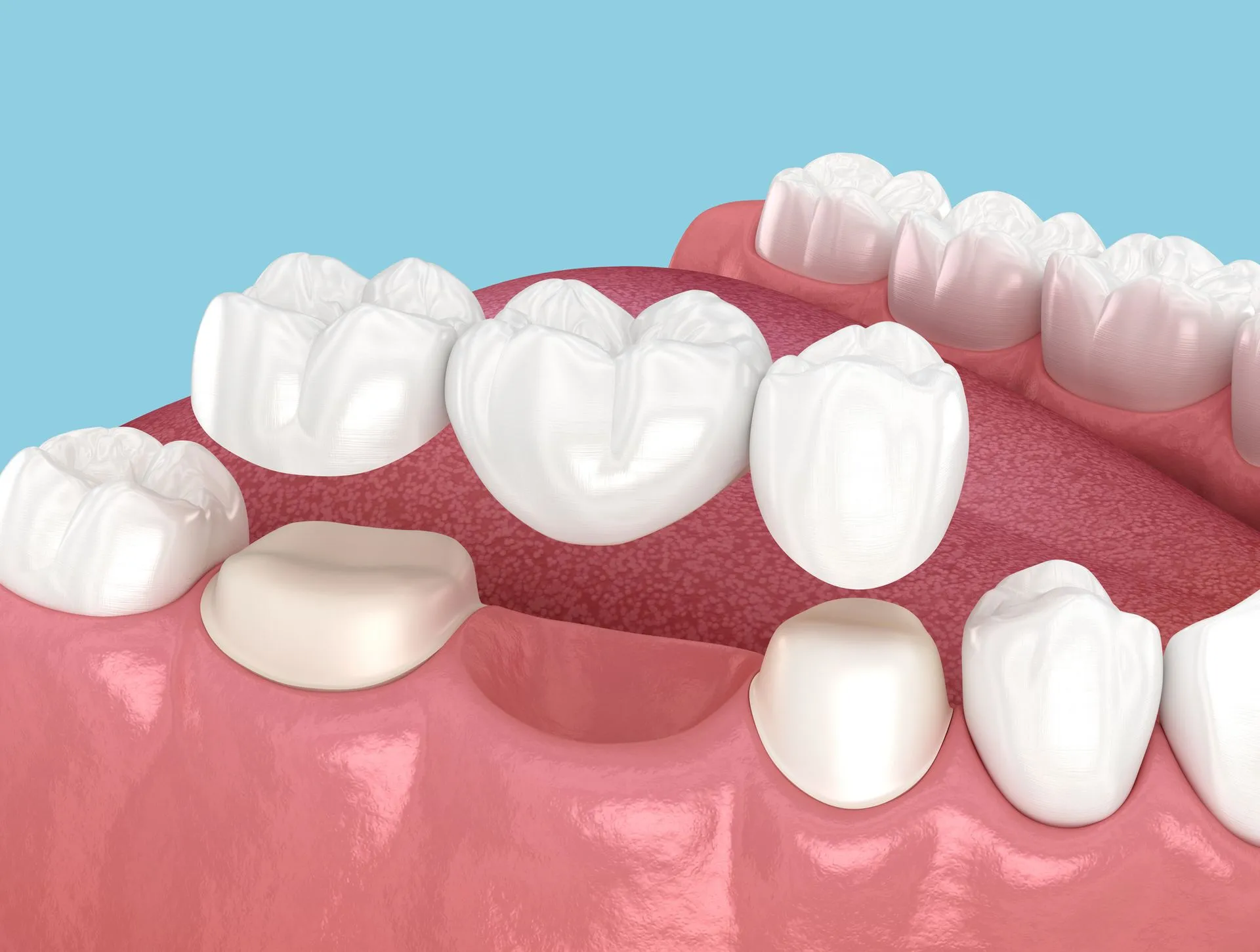 Dental crowns being placed on teeth; showing the process on a pink gum background.
