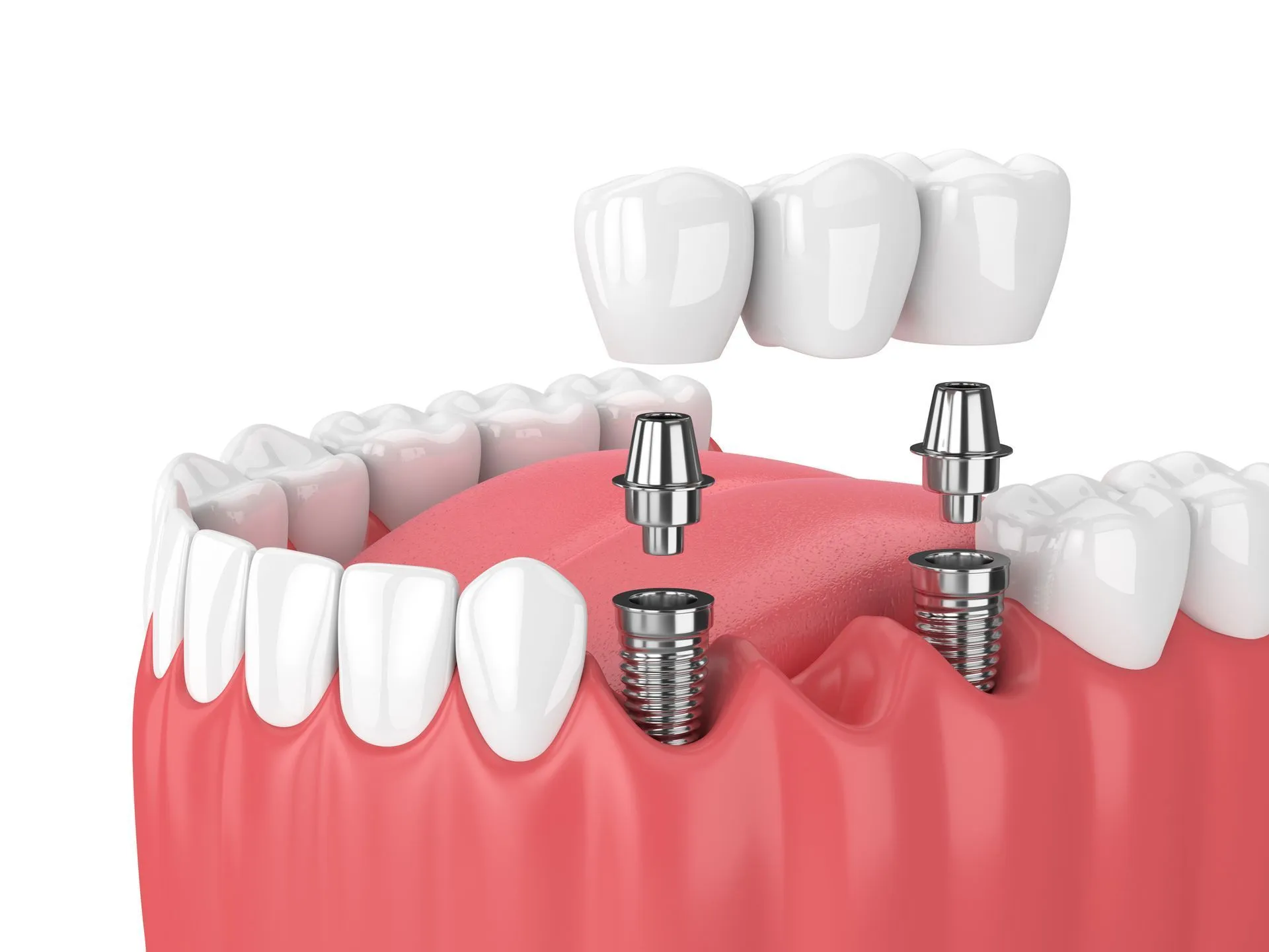 Dental implants and bridge in a mouth model showing procedure.