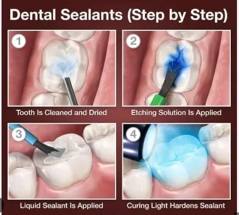 Dental sealant procedure steps: cleaning, etching, applying sealant, hardening with light.