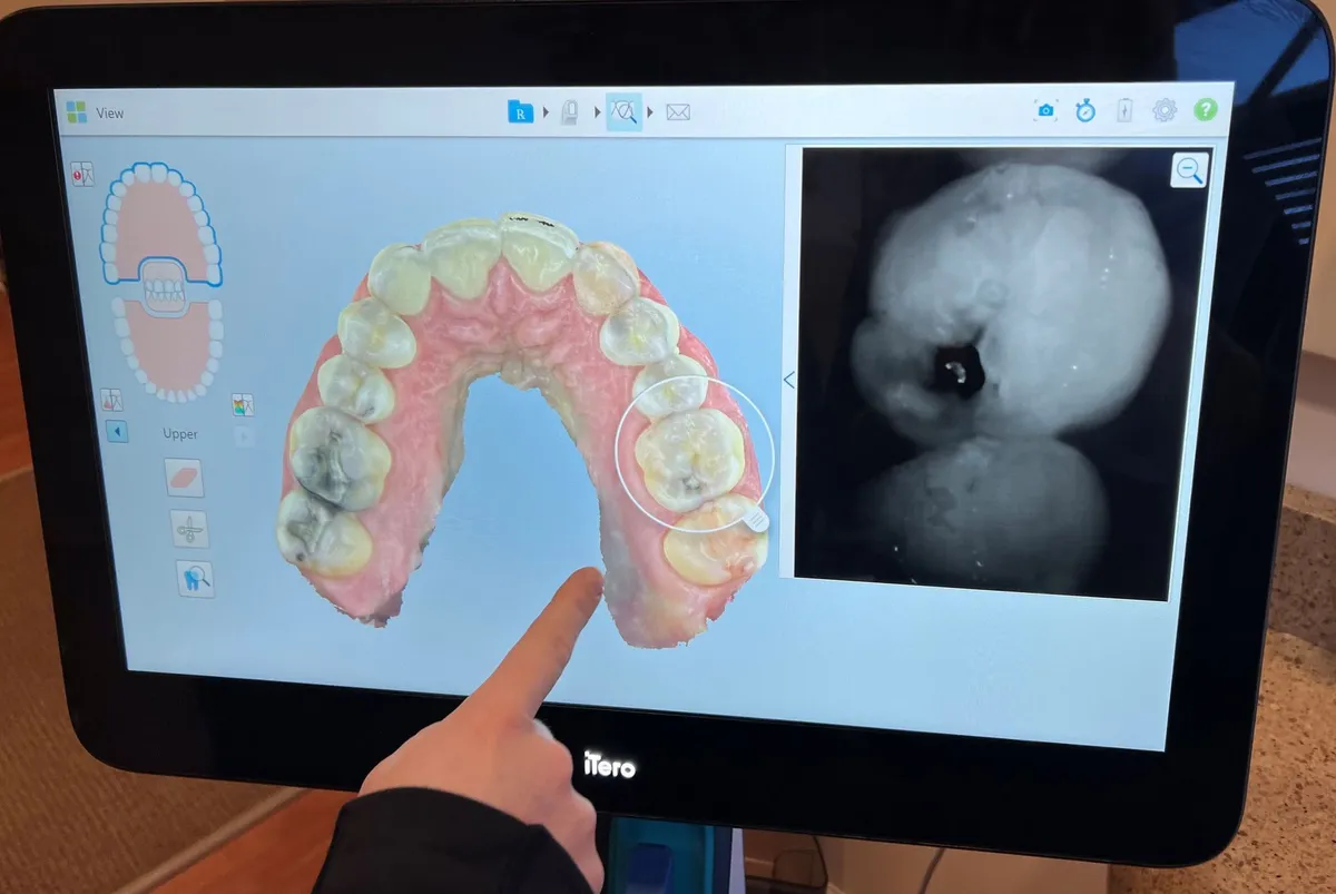 Dentist's hand pointing at a 3D tooth scan and X-ray on a monitor, showing dental work needed.