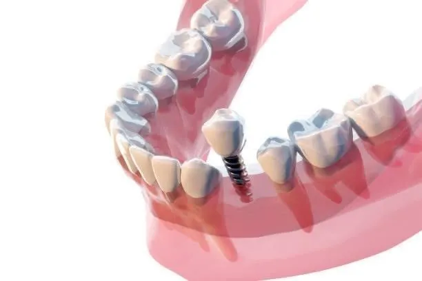 A dental implant with a crown on the lower jaw, close-up.