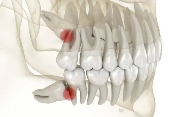 X-ray view of a jaw showing impacted wisdom teeth highlighted in red, indicating pain or infection.